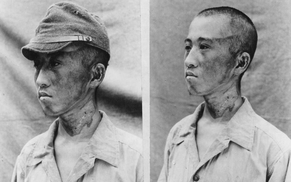 16. Этот пациент (снимок сделан японскими военными 3 октября 1945 года) находился примерно в 1 981,20 м от эпицентра, когда радиационные лучи настигли его слева. Кепка защитила часть головы от ожогов. (U.S. National Archives)