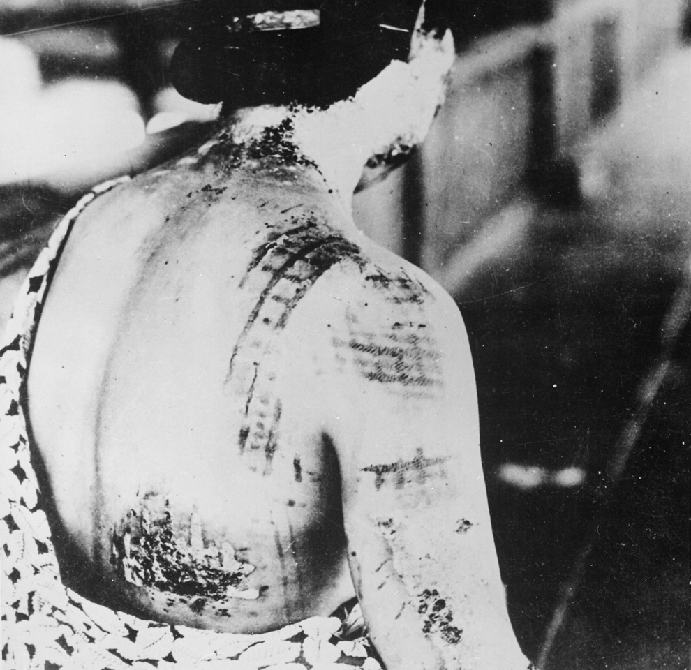24. Из подписи к фотографии этой жертвы Хиросимы: «Ожоги на коже пациента остались в виде темных пятен от кимоно, которое было на жертве в момент взрыва». (U.S. National Archives)