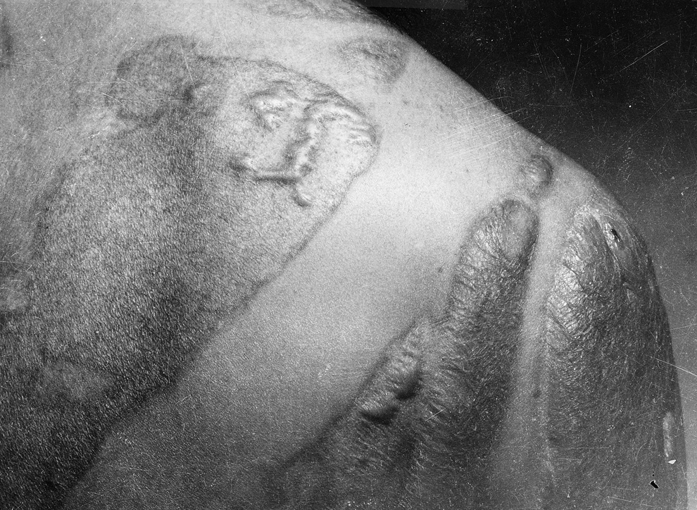 26. Келоидные рубцы на спине и плечах жертвы взрыва в Хиросиме. Шрамы образовались там, где кожа жертвы была не защищена от прямых радиационных лучей. (U.S. National Archives)