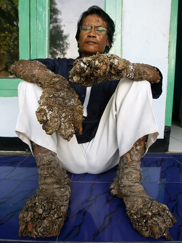 6. Индонезийский рыбак с наростами на руках и ногах, похожими на ветки дерева, сказал в декабре прошлого года, что его состояние ухудшилось, несмотря на хирургическое вмешательство. Деде – «человек-дерево» сказал, что наросты снова появились вскоре после того, как ему удалили их в августе. (SUPRI, Reuters / Corbis)