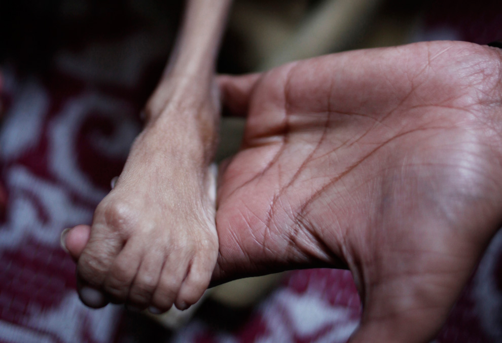 27.  Para fisioterapis terus kaki anak 7 tahun di klinik untuk korban non-pemerintah organisasi buatan manusia bencana di Bhopal, India, 20 November 2009.  (AP Photo / Saurabh Das)