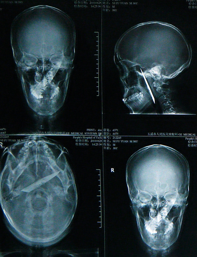 pb 110218 knife skull ps.photoblog900 Китаец прожил четыре года с ножом в черепе