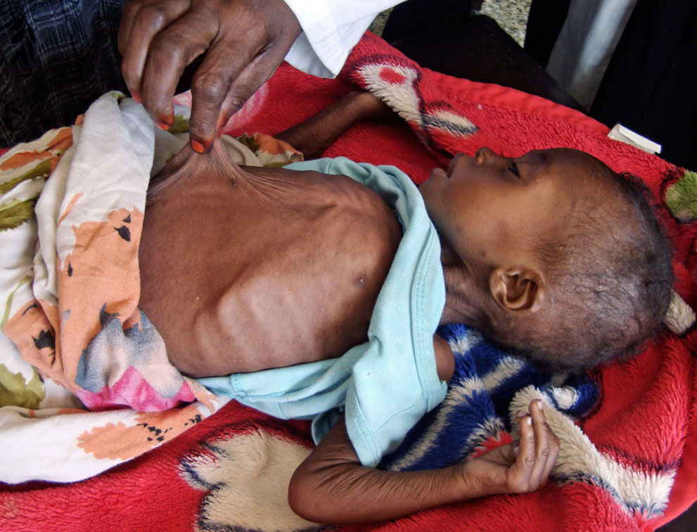 hungymamafrika21 Kelaparan di Afrika Timur