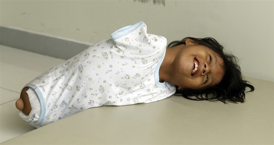 2201 Жизнерадостная девочка инвалид из Перу