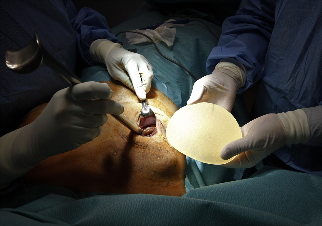 1020 Операция по замене некачественных грудных имплантантов PIP 