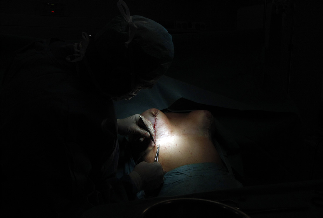 1123 Операция по замене некачественных грудных имплантантов PIP 