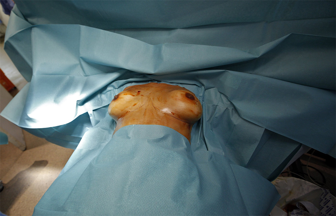 721 Операция по замене некачественных грудных имплантантов PIP 