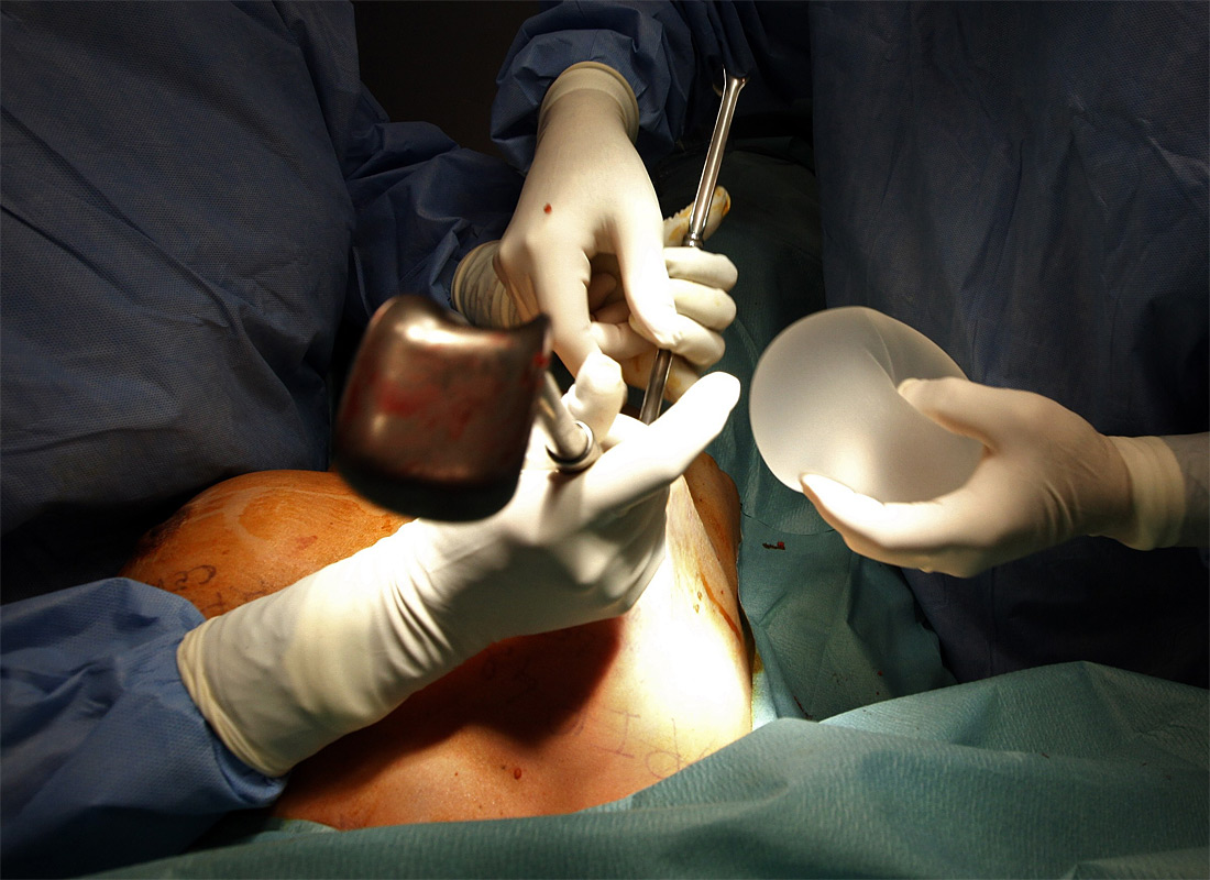 919 Операция по замене некачественных грудных имплантантов PIP 