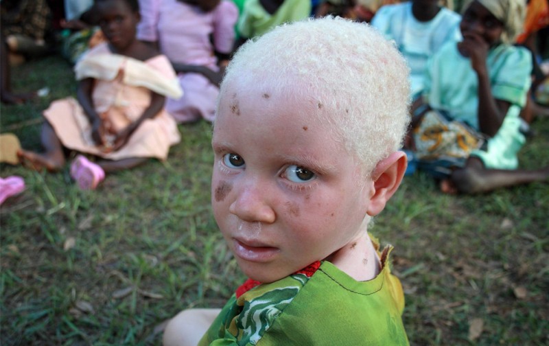 Фотография: Альбиносы в Танзании №10 - BigPicture.ru