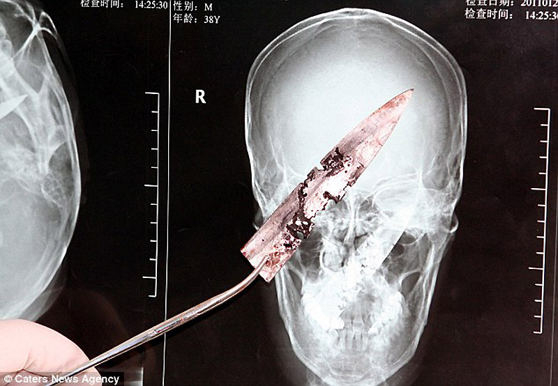 Фотография: Китаец прожил четыре года с ножом в черепе №6 - BigPicture.ru