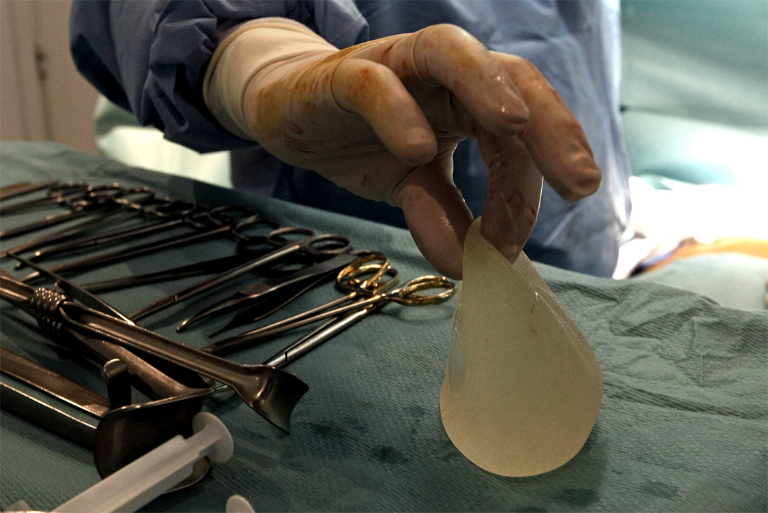 Фотография: Операция по замене некачественных грудных имплантантов PIP №13 - BigPicture.ru