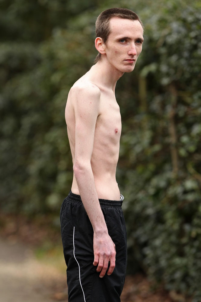 Фотография: 23-летний британец-анорексик боится твердой пищи №8 - BigPicture.ru