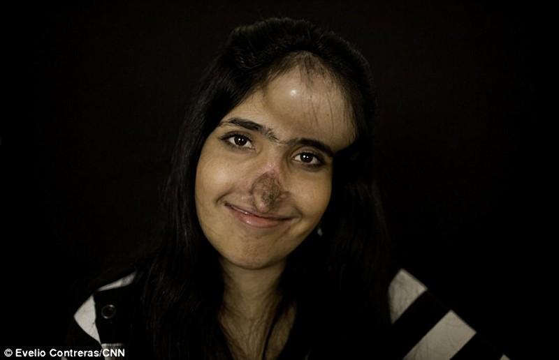 Фотография: Афганской девушке Аише сделали новый нос №8 - BigPicture.ru