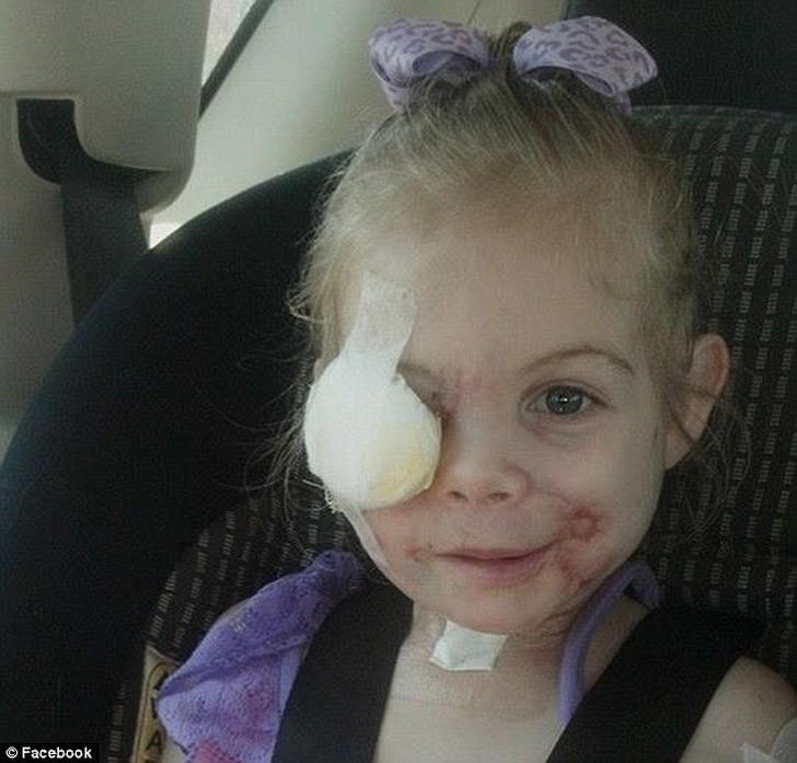 Фотография: 3-летнюю девочку, изуродованную питбулями, выгнали из закусочной из-за ее внешности №4 - BigPicture.ru