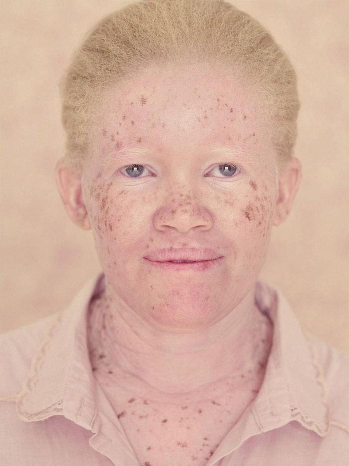Фотография: Не такие, как все: люди-альбиносы №10 - BigPicture.ru