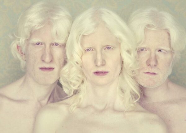 Не такие, как все: люди-альбиносы