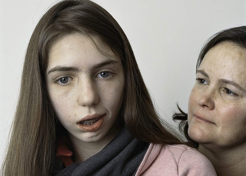Фотография: About Face: фотопортреты людей, страдающих параличом №1 - BigPicture.ru