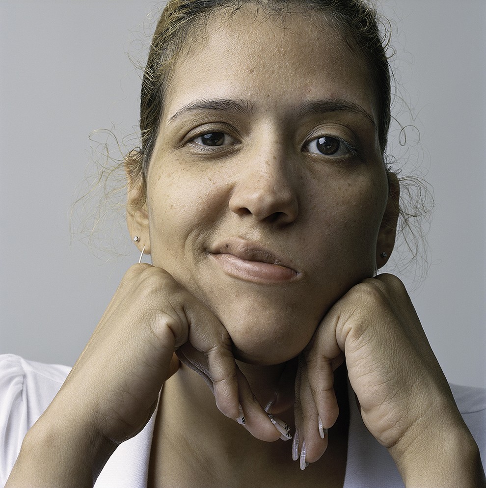 Фотография: About Face: фотопортреты людей, страдающих параличом №5 - BigPicture.ru