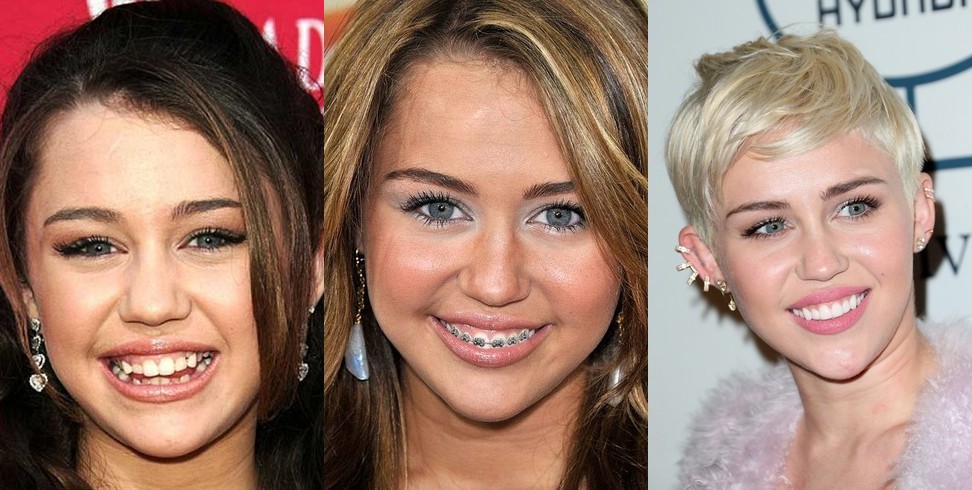 Фотография: Эти знаменитости покажут вам, как кардинально брекеты меняют улыбку №15 - BigPicture.ru