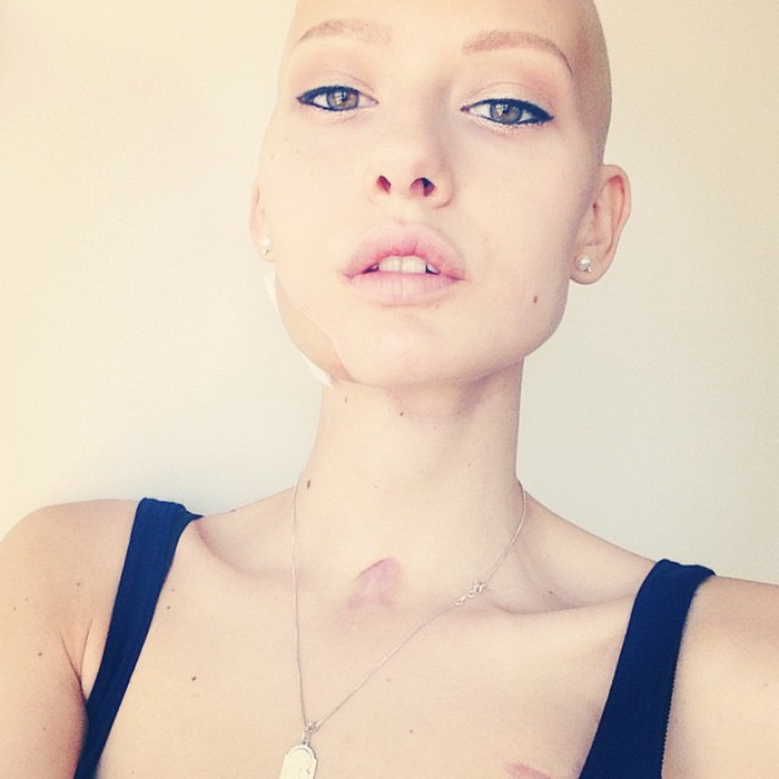 Фотография: Врачи сказали модели сделать аборт после того, как ей удалили 95% челюсти из-за рака, — и вот что она сделала №3 - BigPicture.ru