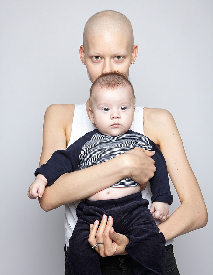 Фотография: Врачи сказали модели сделать аборт после того, как ей удалили 95% челюсти из-за рака, — и вот что она сделала №13 - BigPicture.ru