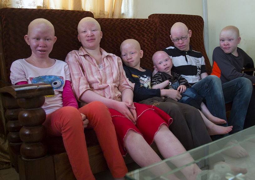 Фотография: Танзанийские альбиносы, чьи тела стоят дороже золота №2 - BigPicture.ru
