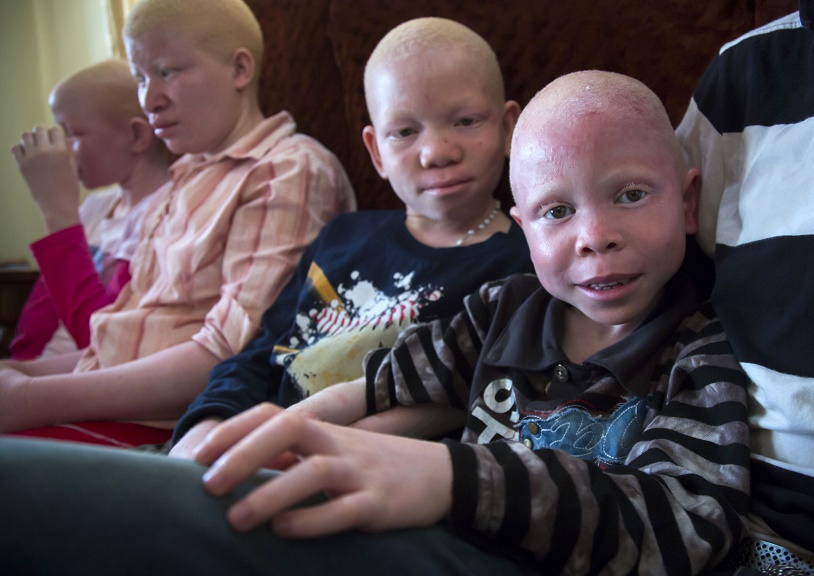 Фотография: Танзанийские альбиносы, чьи тела стоят дороже золота №20 - BigPicture.ru