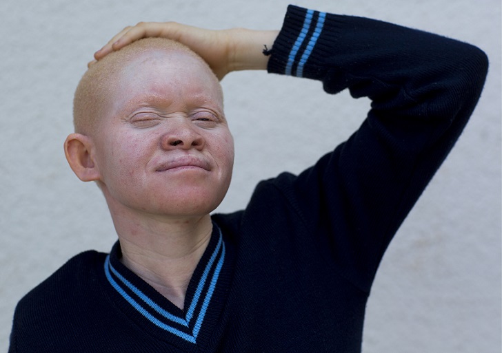 Фотография: Танзанийские альбиносы, чьи тела стоят дороже золота №9 - BigPicture.ru