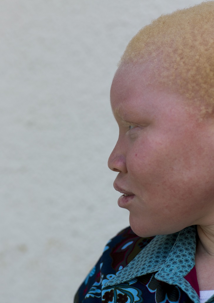Фотография: Танзанийские альбиносы, чьи тела стоят дороже золота №11 - BigPicture.ru