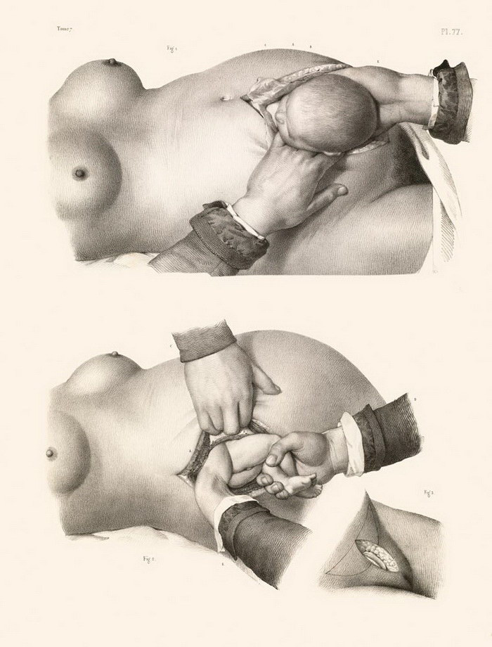 Фотография: Как делали хирургические операции в начале прошлого века №13 - BigPicture.ru