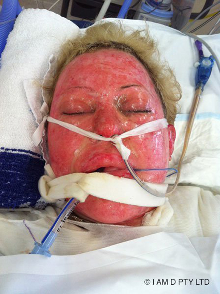 Фотография: Некогда чуть не сгоревшая заживо австралийка наконец сняла свою маску №3 - BigPicture.ru