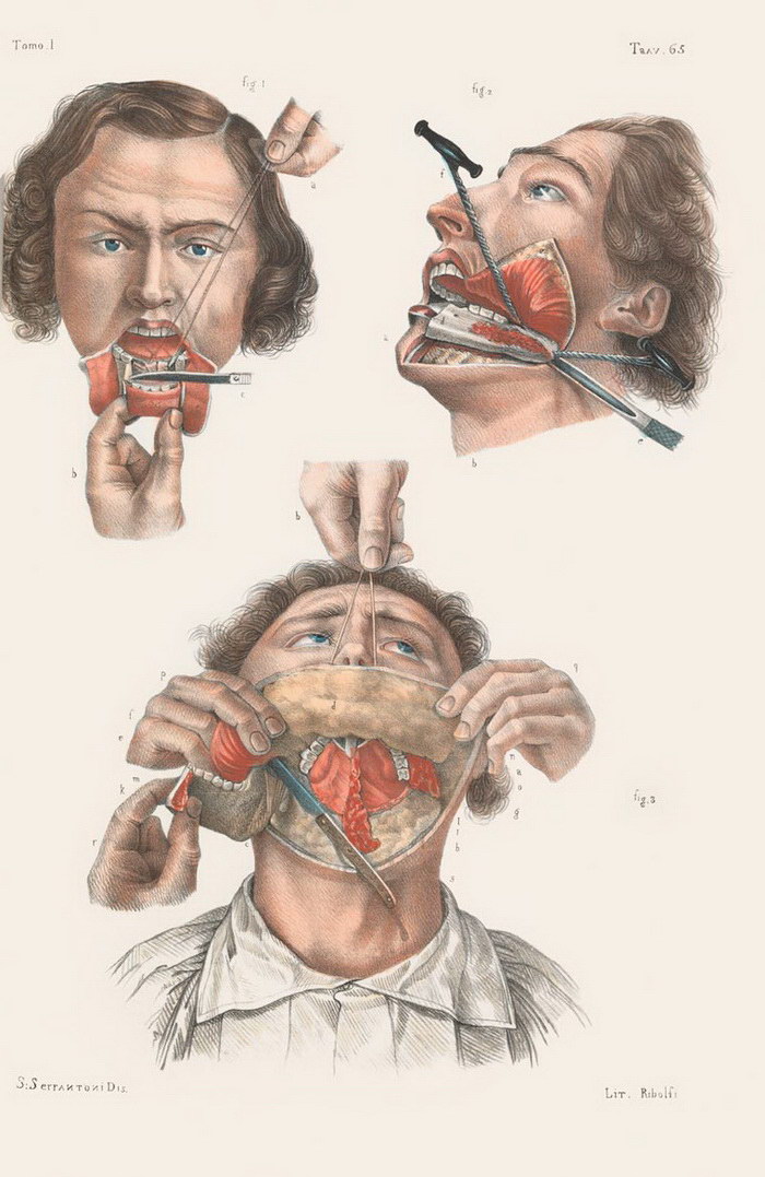 Фотография: Как делали хирургические операции в начале прошлого века №3 - BigPicture.ru