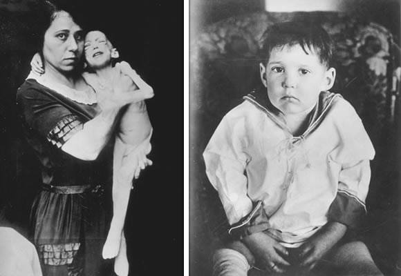 Фотография: 23 января 1922 года была сделана первая инъекция инсулина человеку, которая спасла ему жизнь №1 - BigPicture.ru