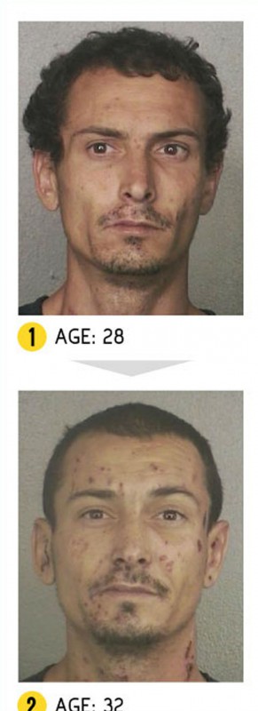 Результат на лицо – как меняется внешность человека из-за наркотиков. ФОТО