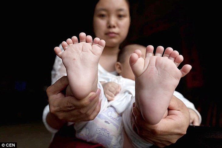 Фотография: В Китае родился мальчик с 31 пальцем №2 - BigPicture.ru