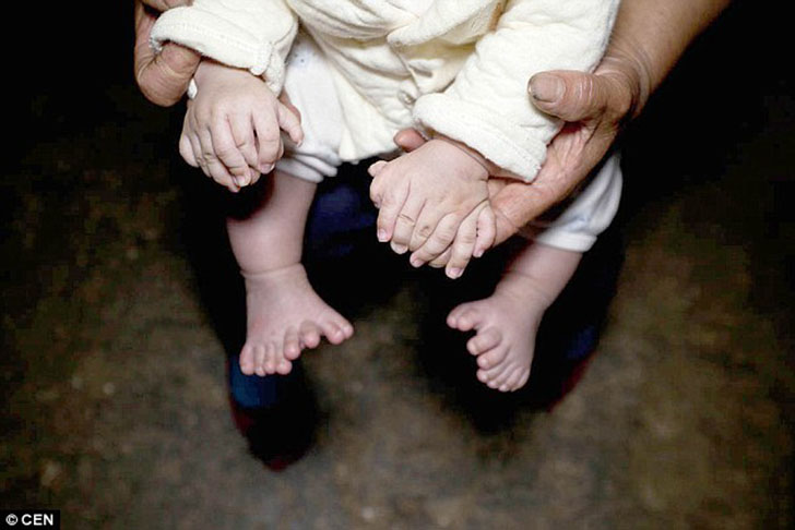 Фотография: В Китае родился мальчик с 31 пальцем №4 - BigPicture.ru