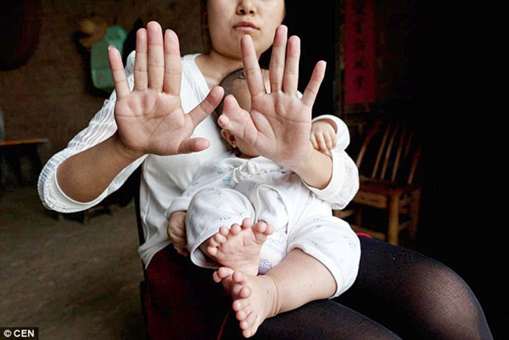 Фотография: В Китае родился мальчик с 31 пальцем №5 - BigPicture.ru