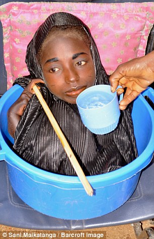 Фотография: Девушка из тазика: история нигерийки с головой взрослой женщины и телом младенца №7 - BigPicture.ru