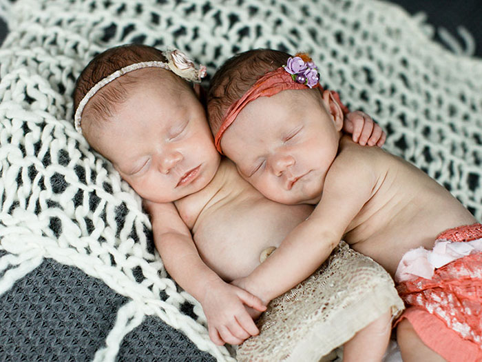 Фотография: Неразлучные двойняшки, державшие друг друга за руку при рождении, два года спустя №6 - BigPicture.ru