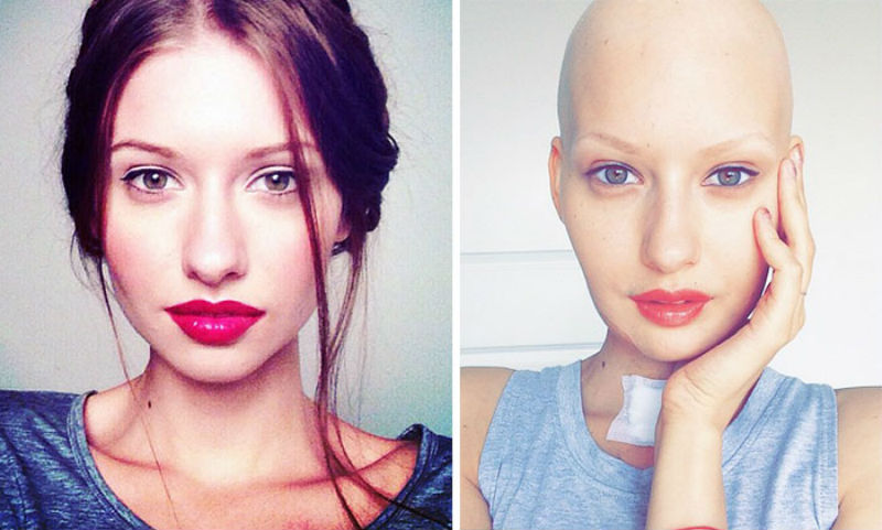 Фотография: Врачи сказали модели сделать аборт после того, как ей удалили 95% челюсти из-за рака, — и вот что она сделала №1 - BigPicture.ru