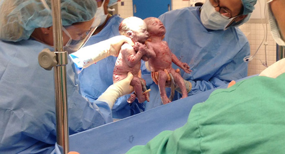 Фотография: Неразлучные двойняшки, державшие друг друга за руку при рождении, два года спустя №1 - BigPicture.ru