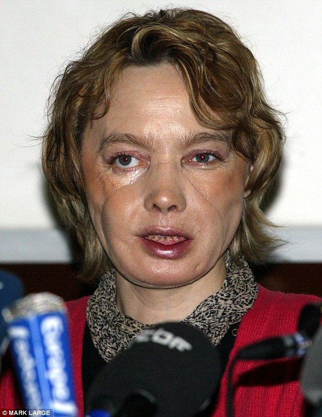 Фотография: Первая женщина с пересаженным лицом умерла от рака, вызванного лекарствами против отторжения трансплантатов №11 - BigPicture.ru