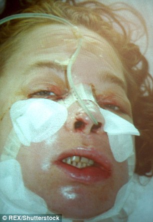 Фотография: Первая женщина с пересаженным лицом умерла от рака, вызванного лекарствами против отторжения трансплантатов №9 - BigPicture.ru