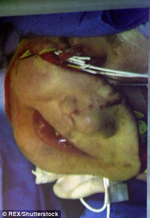 Фотография: Первая женщина с пересаженным лицом умерла от рака, вызванного лекарствами против отторжения трансплантатов №10 - BigPicture.ru