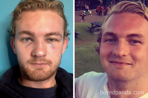 Фотография: До и после: как меняется внешность человека, который перестает пить №17 - BigPicture.ru