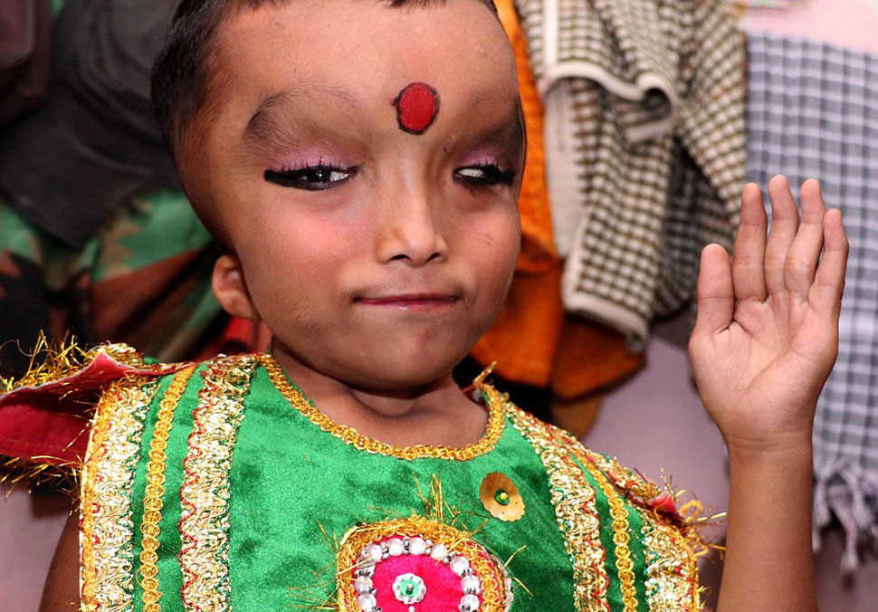 Фотография: Жители индийской деревни поклоняются мальчику с деформированной головой как богу Ганеше №1 - BigPicture.ru
