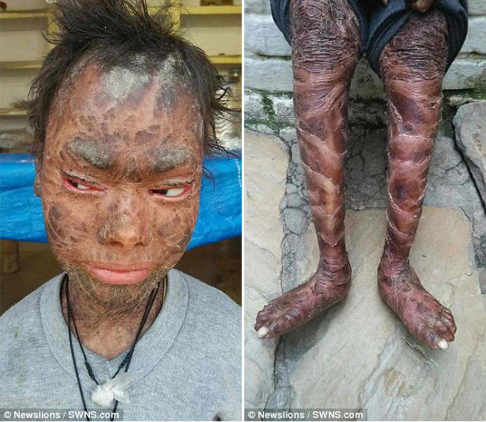 Фотография: Девочка-змея сбрасывает кожу каждые полтора месяца №2 - BigPicture.ru