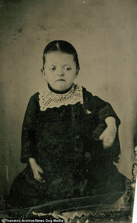 Фотография: Суровый XIX век: коллекция архивных фотографий людей с деформациями №11 - BigPicture.ru