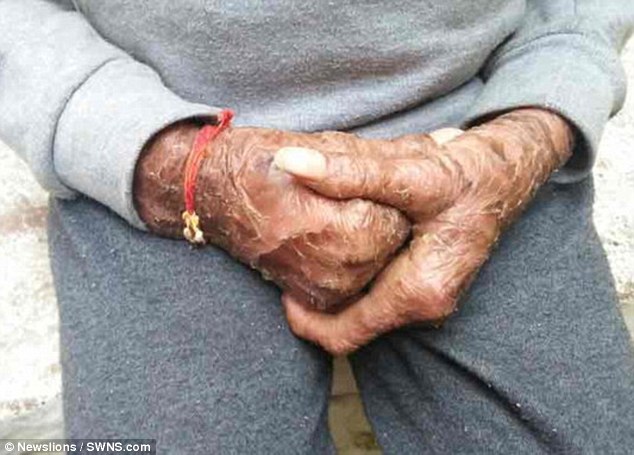 Фотография: Девочка-змея сбрасывает кожу каждые полтора месяца №3 - BigPicture.ru