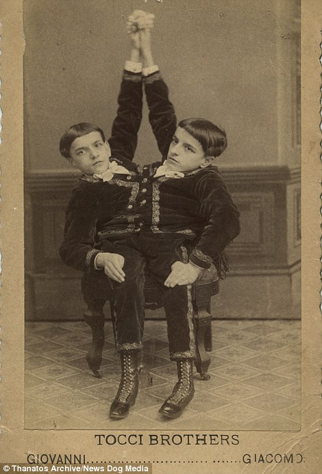 Фотография: Суровый XIX век: коллекция архивных фотографий людей с деформациями №7 - BigPicture.ru